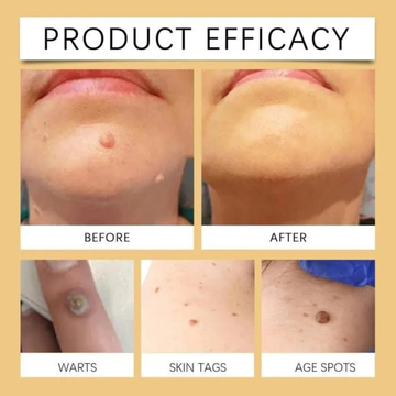 Timilk Wart & Mole Removal Spray | Painless, Fast Acting & Scar Free Skin | Best for Warts, Moles & Skin tags